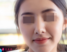 自體脂肪填充臉部價格大概是多少？