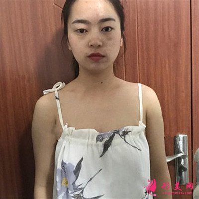 蘭州自體脂肪隆胸術(shù)后恢復(fù)情況分享