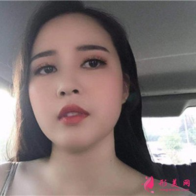 上海眼部綜合手術術后效果分享 術后 上海眼部綜合手術術后效果分享