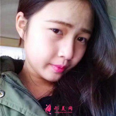 上海眼部綜合手術術后效果分享
