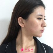 成都軍大面部填充手術(shù)術(shù)后恢復(fù)情況對(duì)比