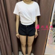 上海華美整形醫(yī)院大腿吸脂心得分享 雙腿白白嫩嫩 又細(xì)又長(zhǎng)