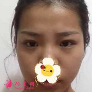 上海九院激光去眼袋案例，效果很顯著 恢復(fù)雙眼色彩
