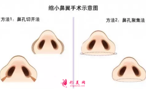 鼻翼縮小手術(shù)的價(jià)格費(fèi)用是多少