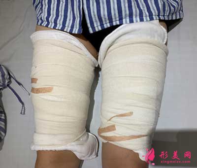 去上海華美找張麗麗做大腿吸脂手術后
