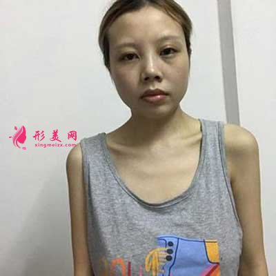 去北京麗都醫(yī)療美容醫(yī)院做自體脂肪隆胸手術(shù)前