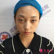 早就聽(tīng)說(shuō)成都軍建做鼻綜合效果很不錯(cuò)，終于我也來(lái)這里做啦~