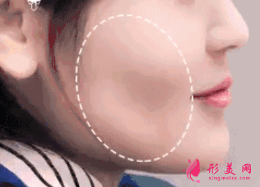 自體脂肪填充臉部前要做什么準(zhǔn)備