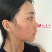 重慶聯(lián)合麗格美容醫(yī)院面部線雕術(shù)后恢復(fù)情況對(duì)比