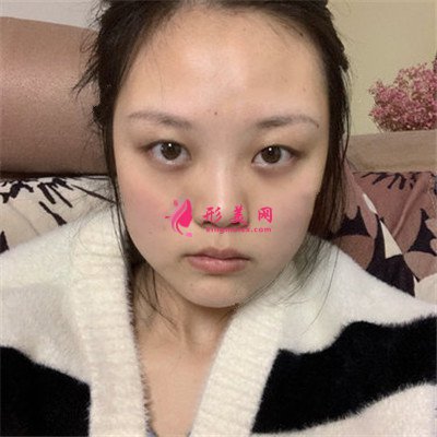 昆明眼部綜合術后恢復效果反饋