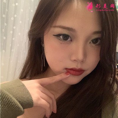 昆明眼部綜合術后恢復效果反饋 術后 昆明眼部綜合術后恢復效果反饋