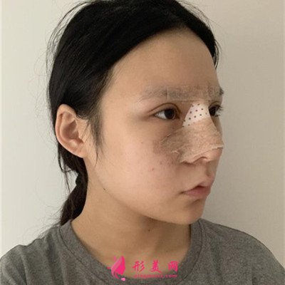 北京硅膠假體隆鼻術(shù)后恢復(fù)效果展示