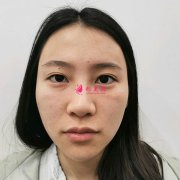 重慶愛思特整形美容醫(yī)院耳軟骨鼻修復效果分享