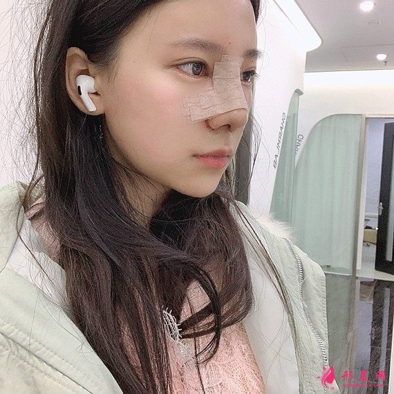 立場(chǎng)簡(jiǎn)單的整形術(shù)后圖片