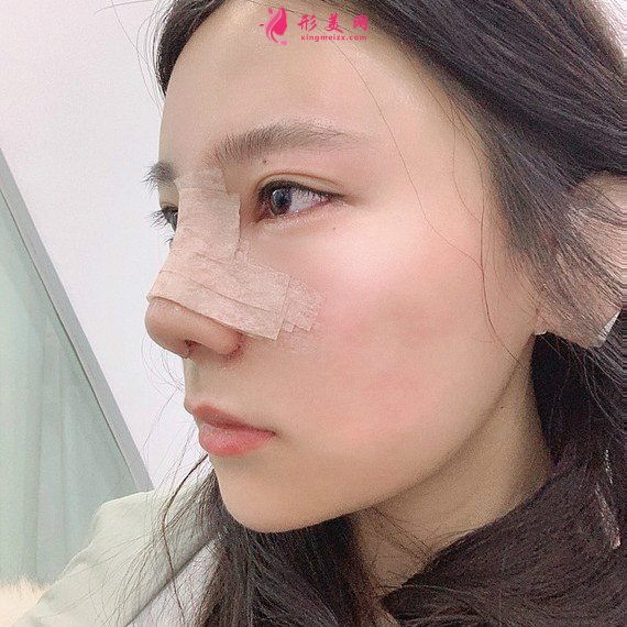立場(chǎng)簡(jiǎn)單的整形術(shù)后圖片