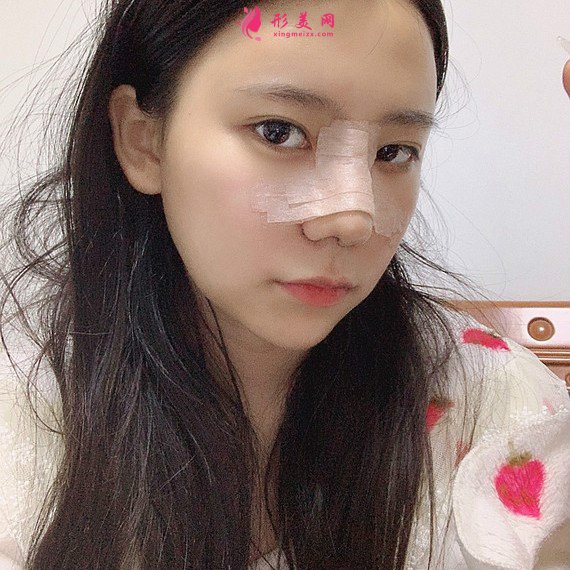 立場(chǎng)簡(jiǎn)單的整形術(shù)后圖片