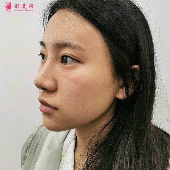 整形前后對(duì)比圖片