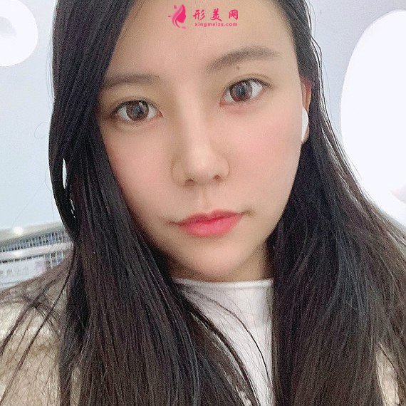 立場(chǎng)簡(jiǎn)單的整形術(shù)后圖片