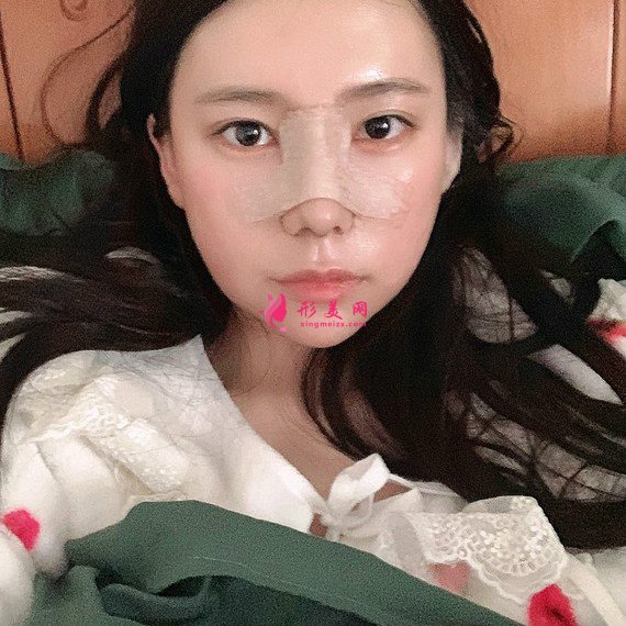 立場(chǎng)簡(jiǎn)單的整形術(shù)后圖片