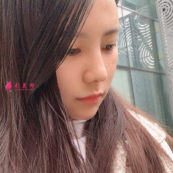 立場(chǎng)簡(jiǎn)單的整形術(shù)后圖片