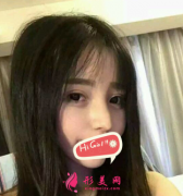 上海東方醫(yī)院整形科鷹鉤鼻矯正案例 恢復(fù)過程對(duì)比圖
