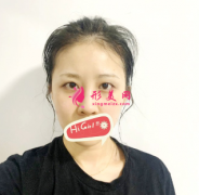 上海華美整形醫(yī)院切開雙眼皮效果圖 眼睛變大后更漂亮了