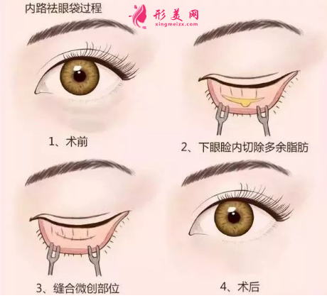 手術切除眼袋后要怎么護理