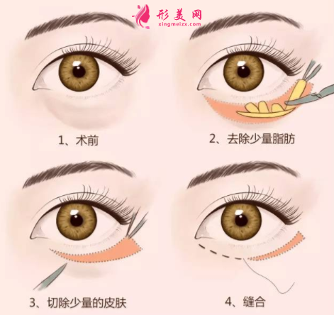 手術(shù)切除眼袋大約要多少錢