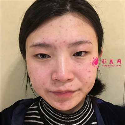 成都切開雙眼皮術后恢復情況對比