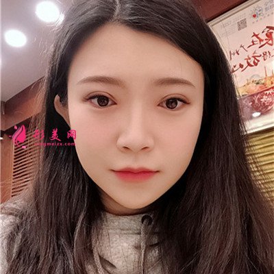 成都切開雙眼皮術后恢復情況對比 術后 成都切開雙眼皮術后恢復情況對比