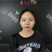 武漢藝星醫(yī)療美容醫(yī)院小姐姐的眼綜合術(shù)后效果展示