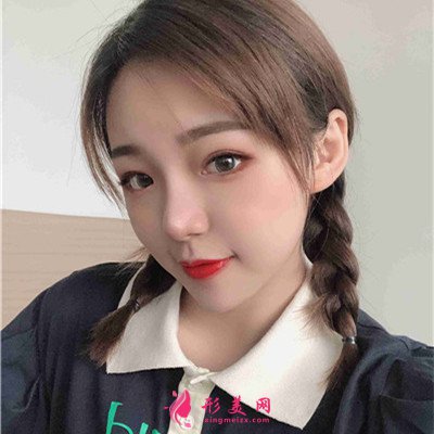 武漢小姐姐的眼綜合術(shù)后效果展示 術(shù)后 武漢小姐姐的眼綜合術(shù)后效果展示