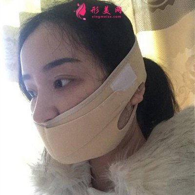 鄭州吸脂瘦臉術(shù)后恢復(fù)情況對(duì)比