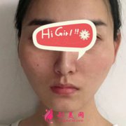 上海華美醫(yī)療美容醫(yī)院顴骨內推案例，高清效果圖曝光超美麗