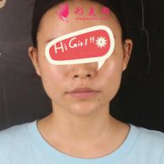 鄭州大學(xué)附二院做下頜角磨骨后臉小了好多 蛻變?nèi)沼?></a><p class=