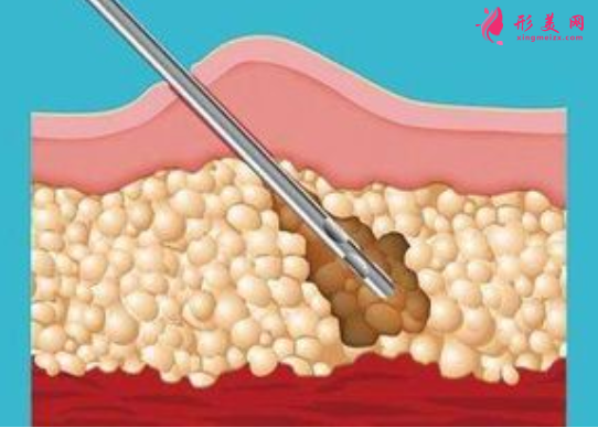 腰腹部吸脂后要按摩嗎