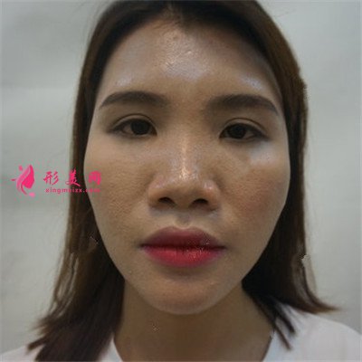 三亞自體肋軟骨隆鼻術(shù)后恢復(fù)效果分享