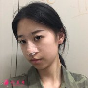 廣州曙光醫(yī)學(xué)美容醫(yī)院硅膠假體隆鼻術(shù)后恢復(fù)情況反饋