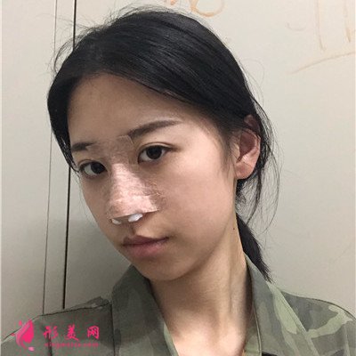 武漢硅膠假體隆鼻術(shù)后恢復(fù)情況反饋