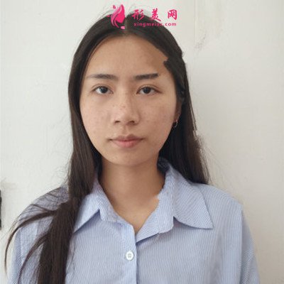 杭州激光祛斑治療后效果分享