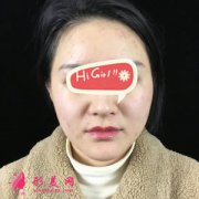 上海九院整形科熱瑪吉除皺案例 半年后效果圖 值得做嗎