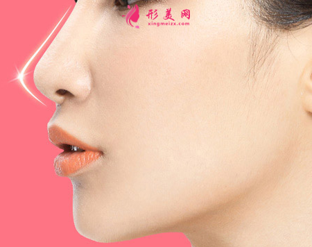 假體隆鼻大概要花多少錢(qián)