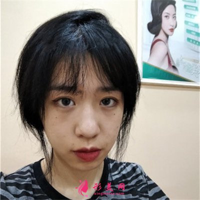 重慶小姐姐埋線雙眼皮術(shù)后恢復(fù)情況反饋