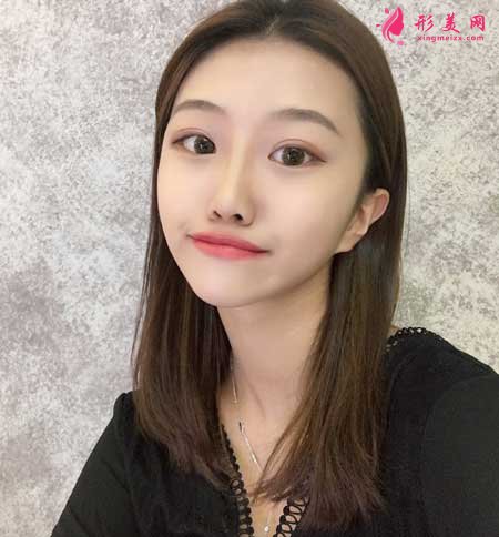 去上海九院做了下頜角截骨手術(shù),我也是精致小臉了