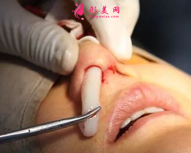 隆鼻假體取出后要注意的事項(xiàng)