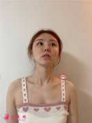 鄭州附二院做M唇手術術后恢復效果反饋