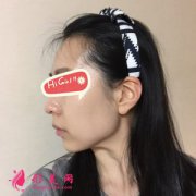 北京南加整形醫(yī)院下頜角磨骨親身體驗 臉小了好多呀 很自然