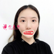 上海九院整形科鷹鉤鼻矯正前后照片對(duì)比 360度無死角