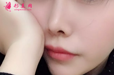 做鼻翼縮小手術要注意的事項