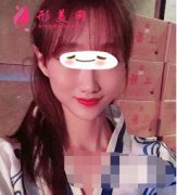 浙大附屬第二醫(yī)院玻尿酸豐面頰手術 玻尿酸豐面頰效果